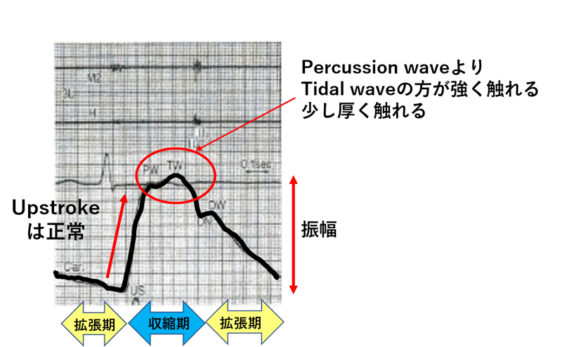 図2 正常の頸動脈波形(高齢)